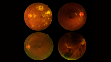 Image of glaucoma